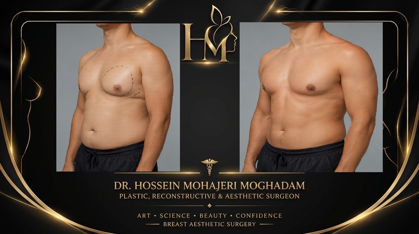 ژنیکوماستی دکتر حسین مهاجری11