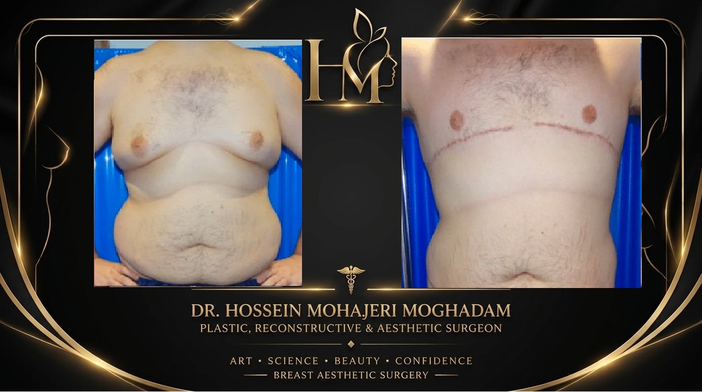ژنیکوماستی دکتر حسین مهاجری12