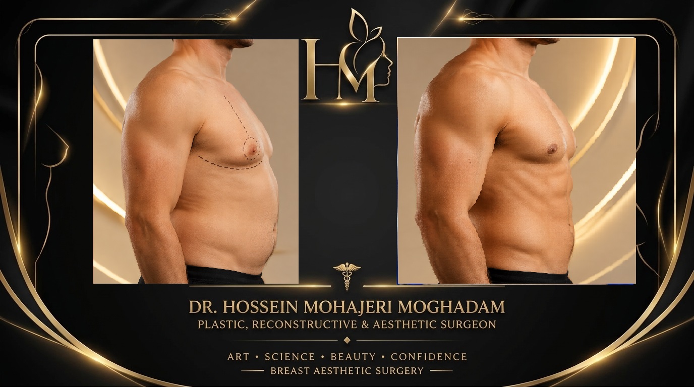 ژنیکوماستی دکتر حسین مهاجری13