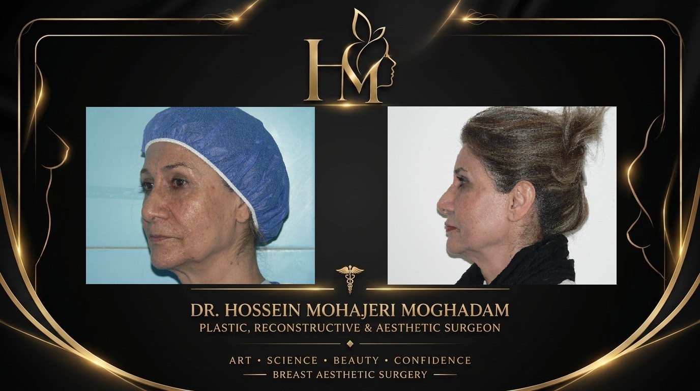 تزریق چربی